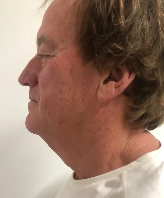 HIFU facial treatment result showing jaw and neck profile — Forever Young Werribee